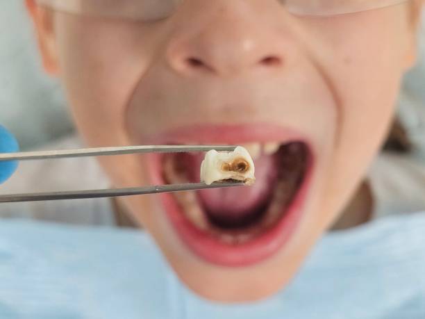 Best Tooth Infection Emergency Dentist  in Gillette, WY